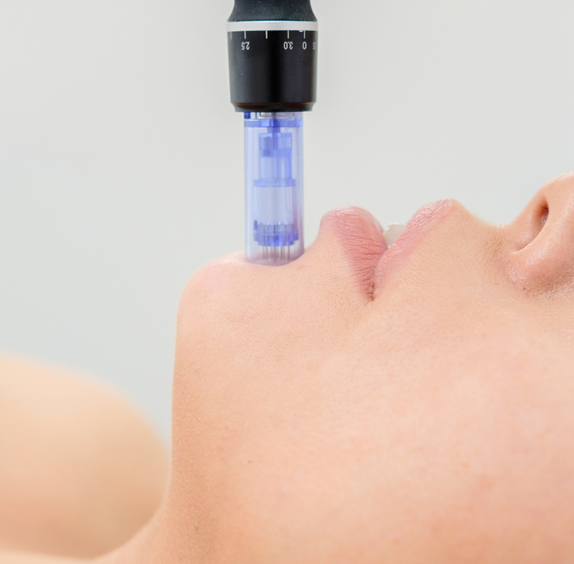 Microneedling