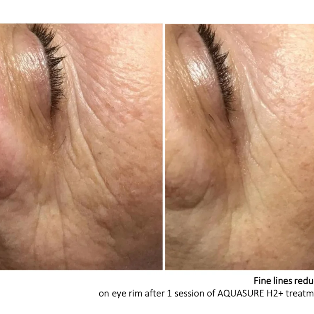 Aquasure H2+ Device: Aquapeel, Galvanic & Cold Plasma
