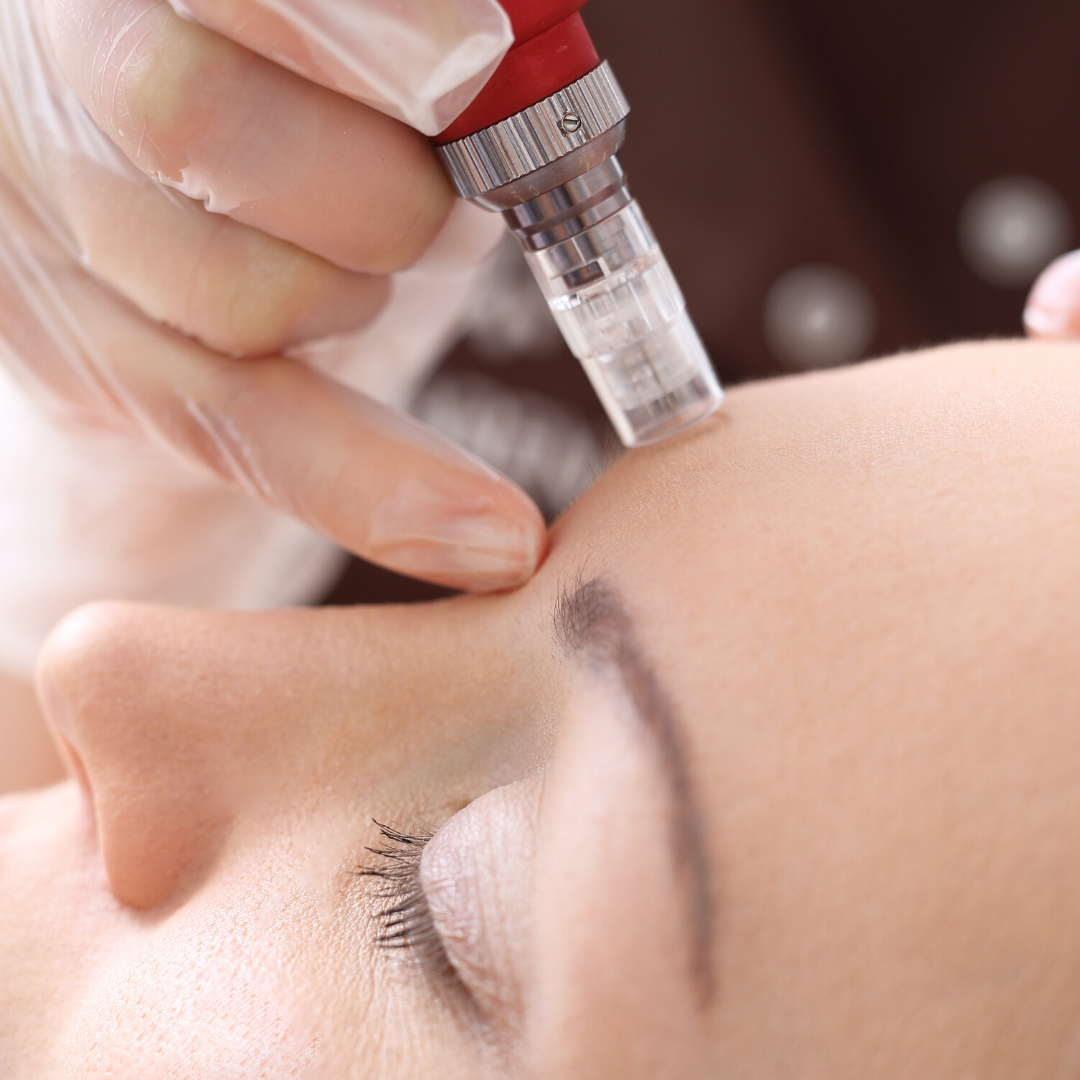 Why Your Spa Should Incorporate Microneedling