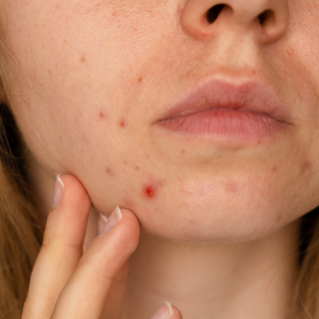 Clear Skin 101: Managing Acne in the treatment room and at home