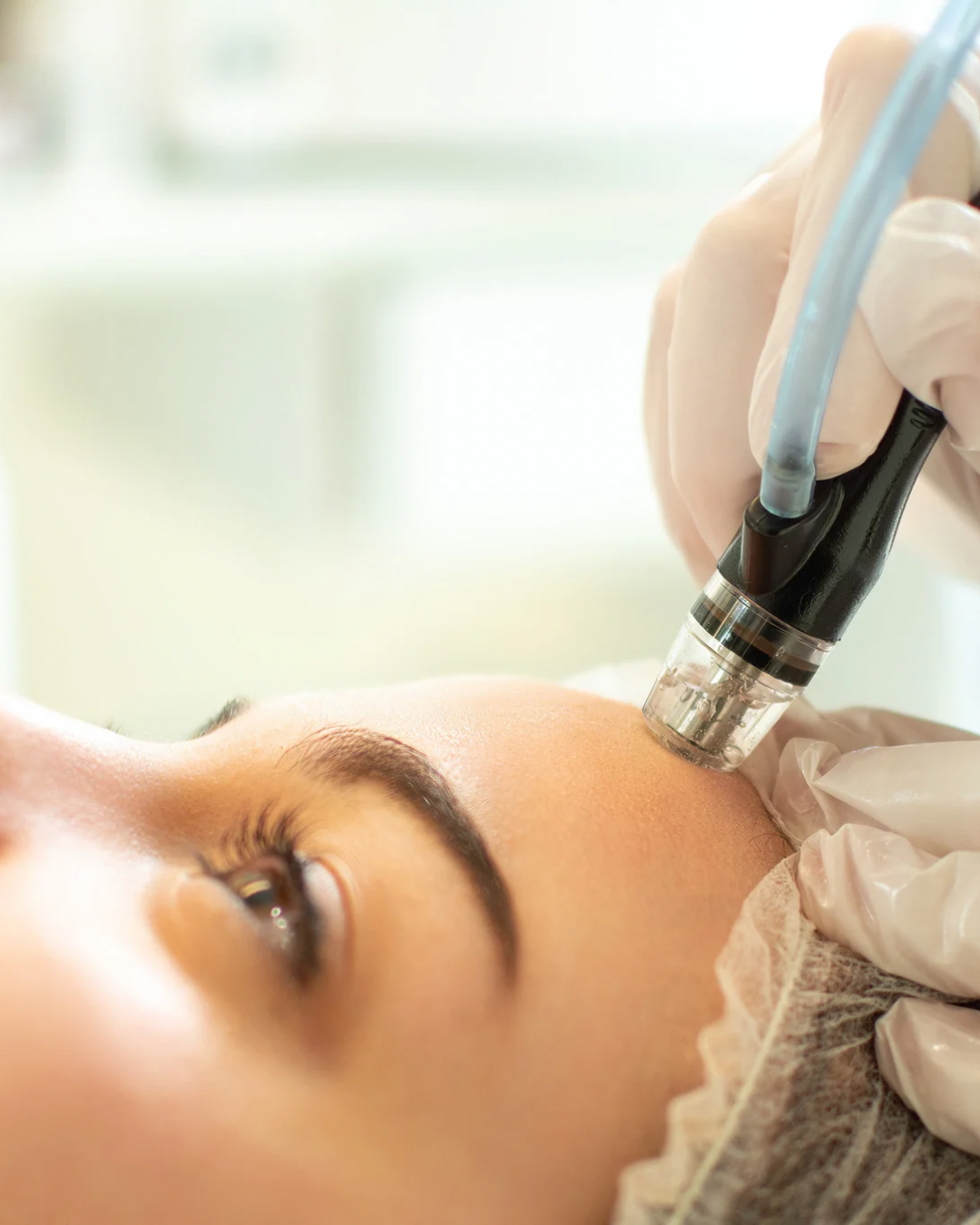 Stonhart Glow & Go Dermabrasion Facial in Student Clinic