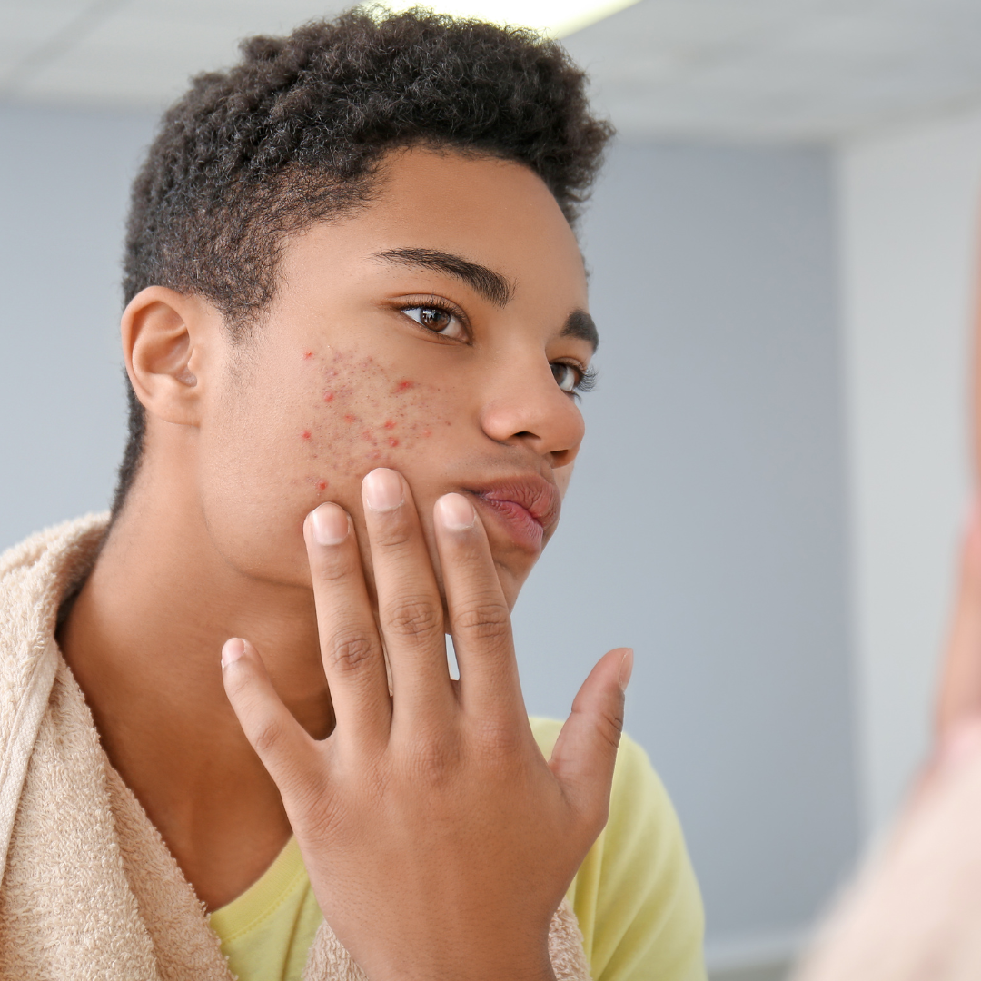 Understanding Acne Certification