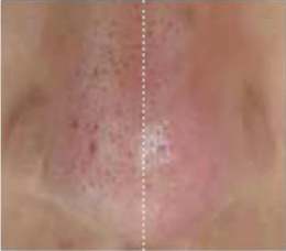 Aquasure H2+ Device: Aquapeel, Galvanic & Cold Plasma