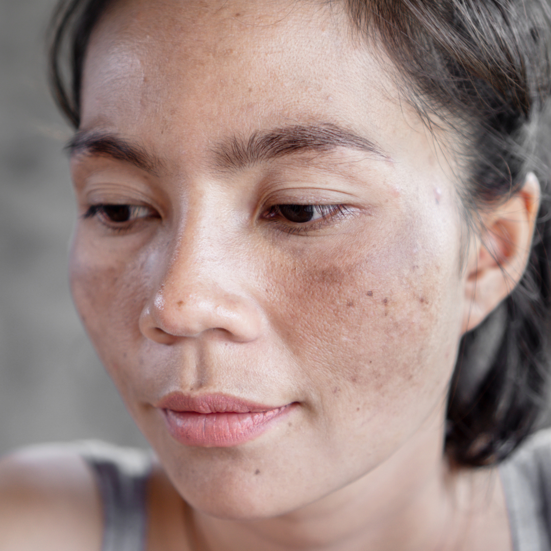 Esthetician's Role In Managing Hyperpigmentation