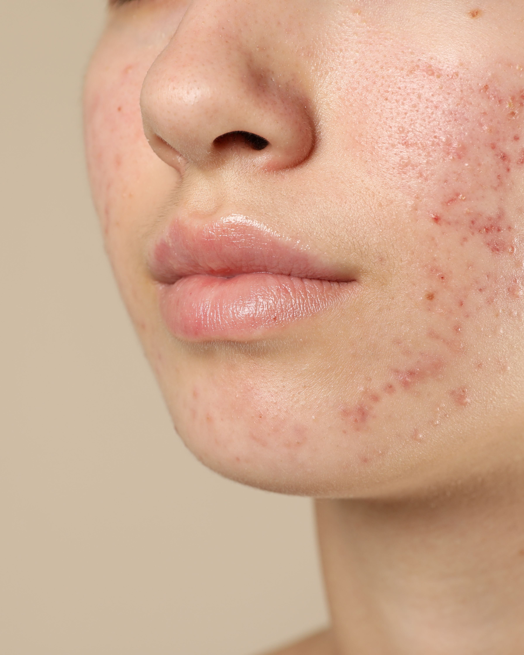 Understanding Acne Online Certification