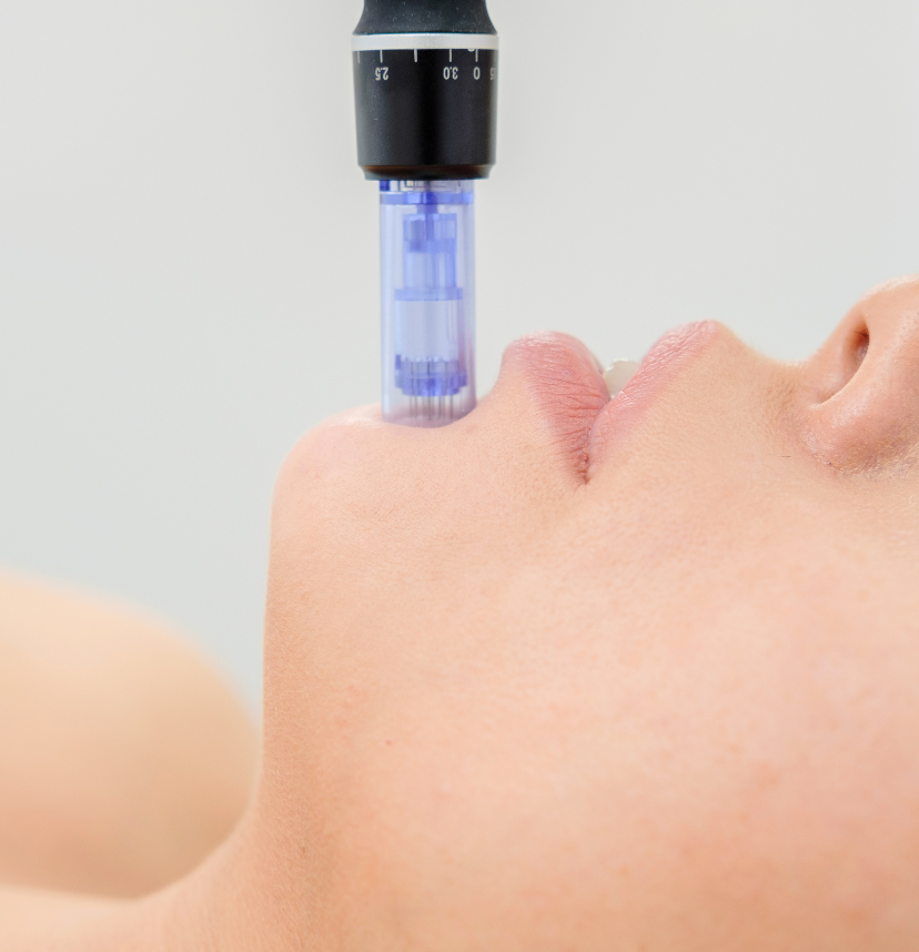Stonhart Microneedling Service in Student Clinic