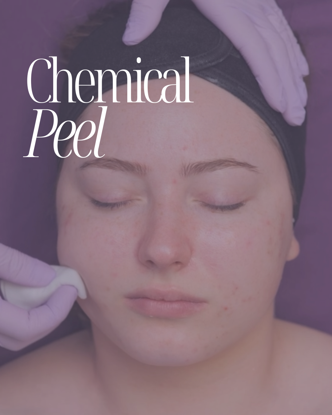 Mastering Chemical Peels Online Certification